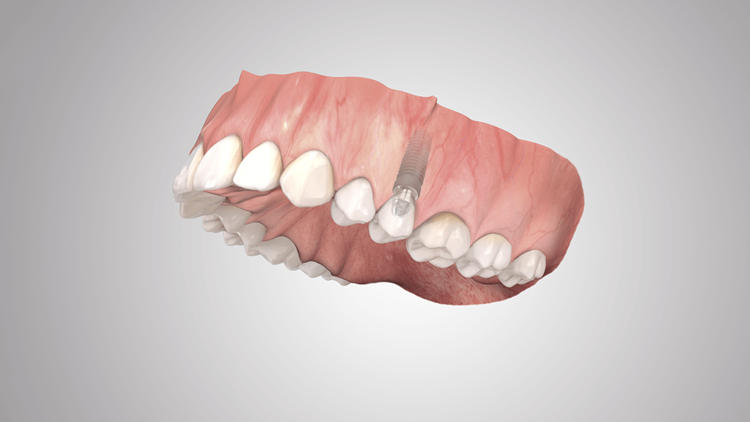 COMFOUR System single-tooth restoration COMFOUR System single-tooth restoration