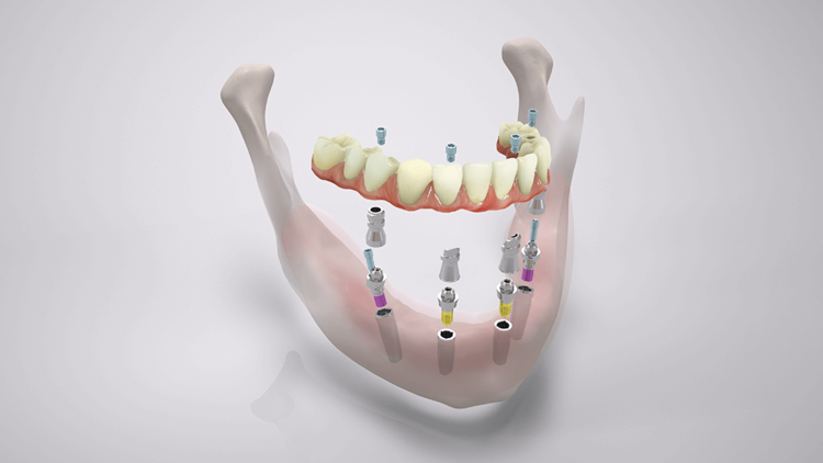 COMFOUR System screw-retained bridge COMFOUR System screw-retained bridge