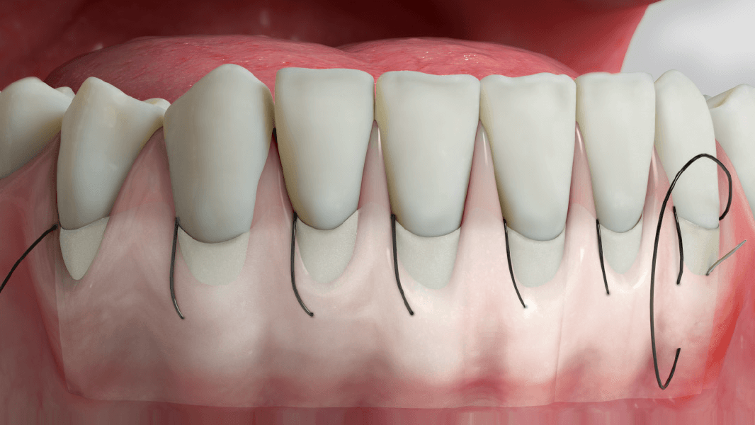 Recession coverage – tunnel technique